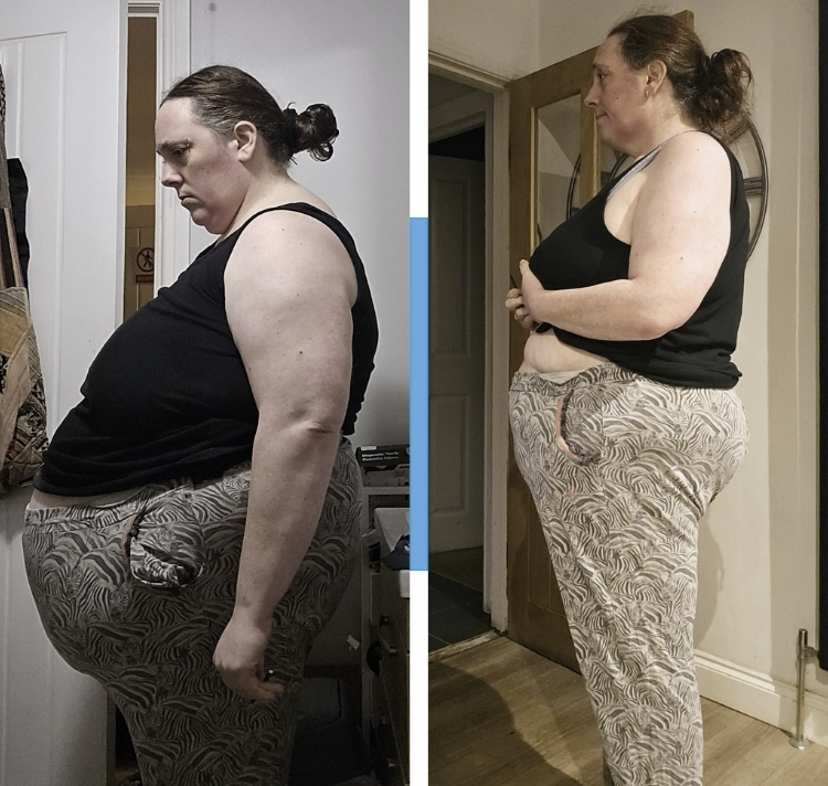 Side Profile Transformation — Real NYP Result